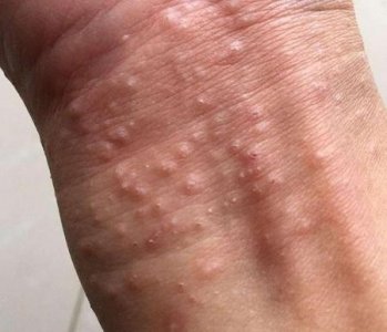 ​感染hpv身体会长东西吗?(hpv感染身上会长疙瘩吗)