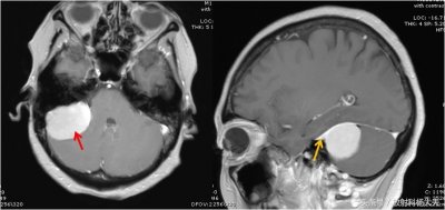 ​千变万化的影像征象系列（4）：脑膜尾征